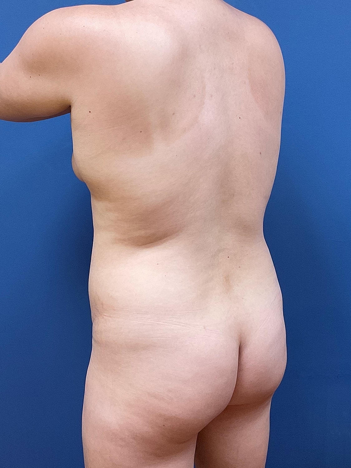 Liposuction Before & After