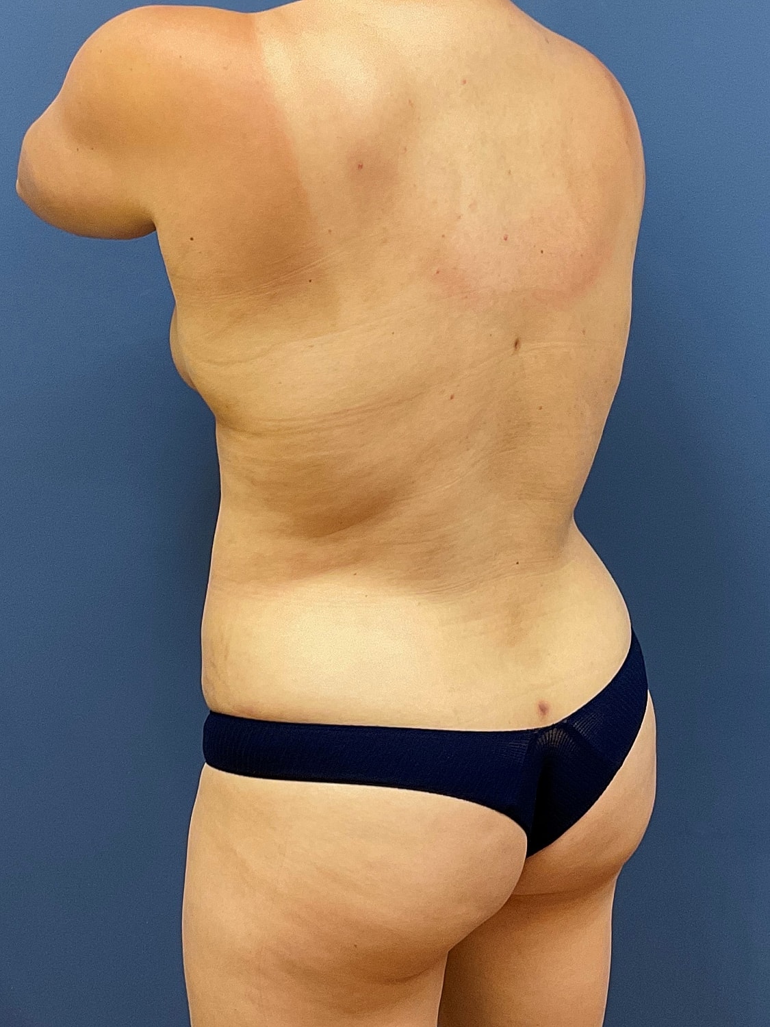 Liposuction Before & After