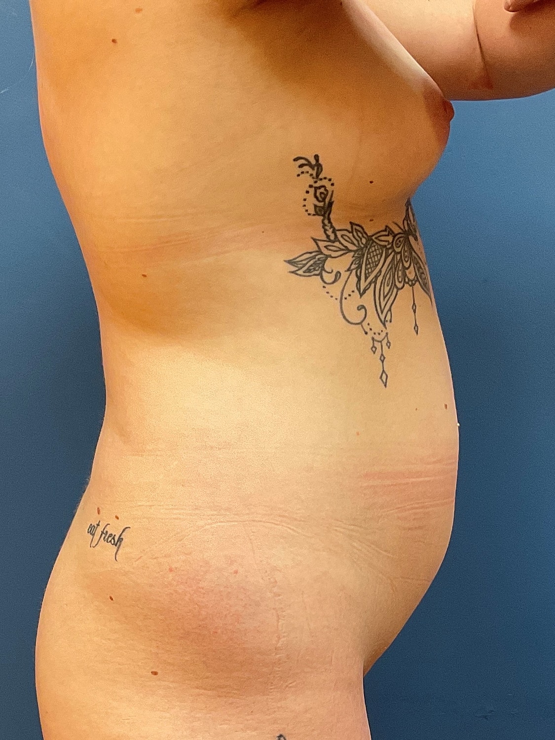 Liposuction Before & After