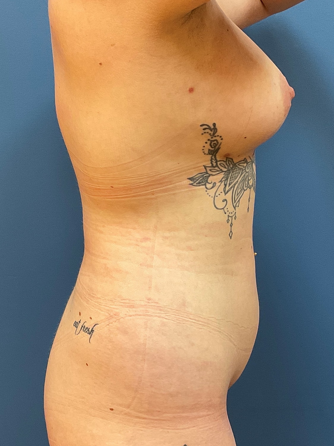 Liposuction Before & After
