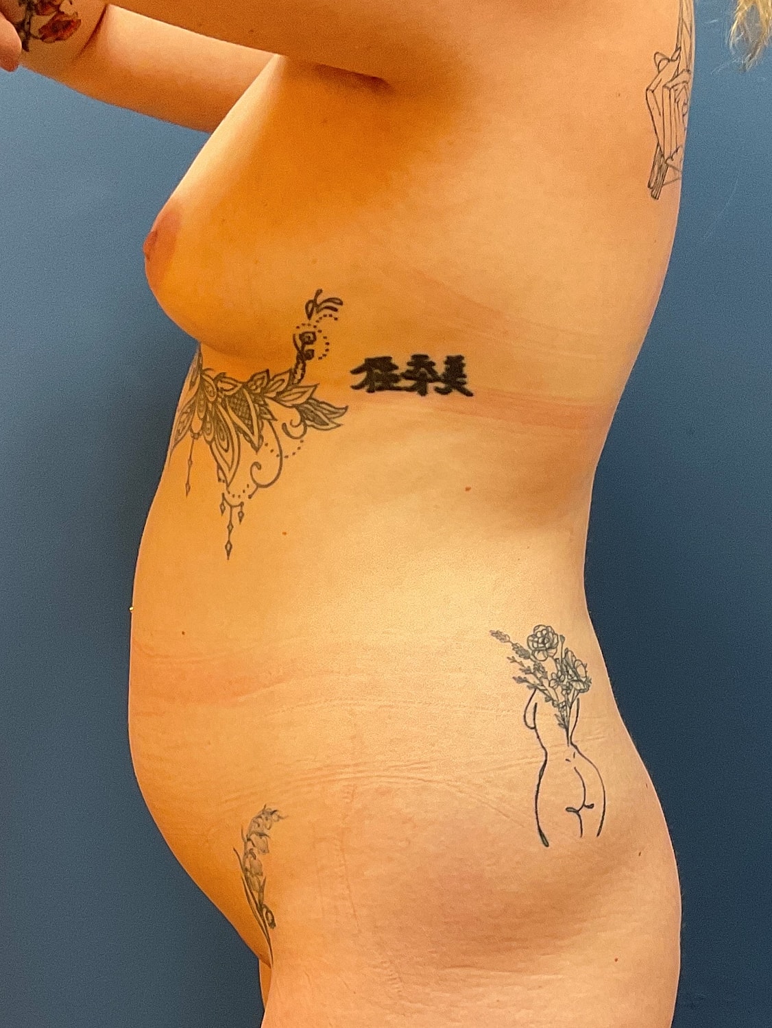 Liposuction Before & After