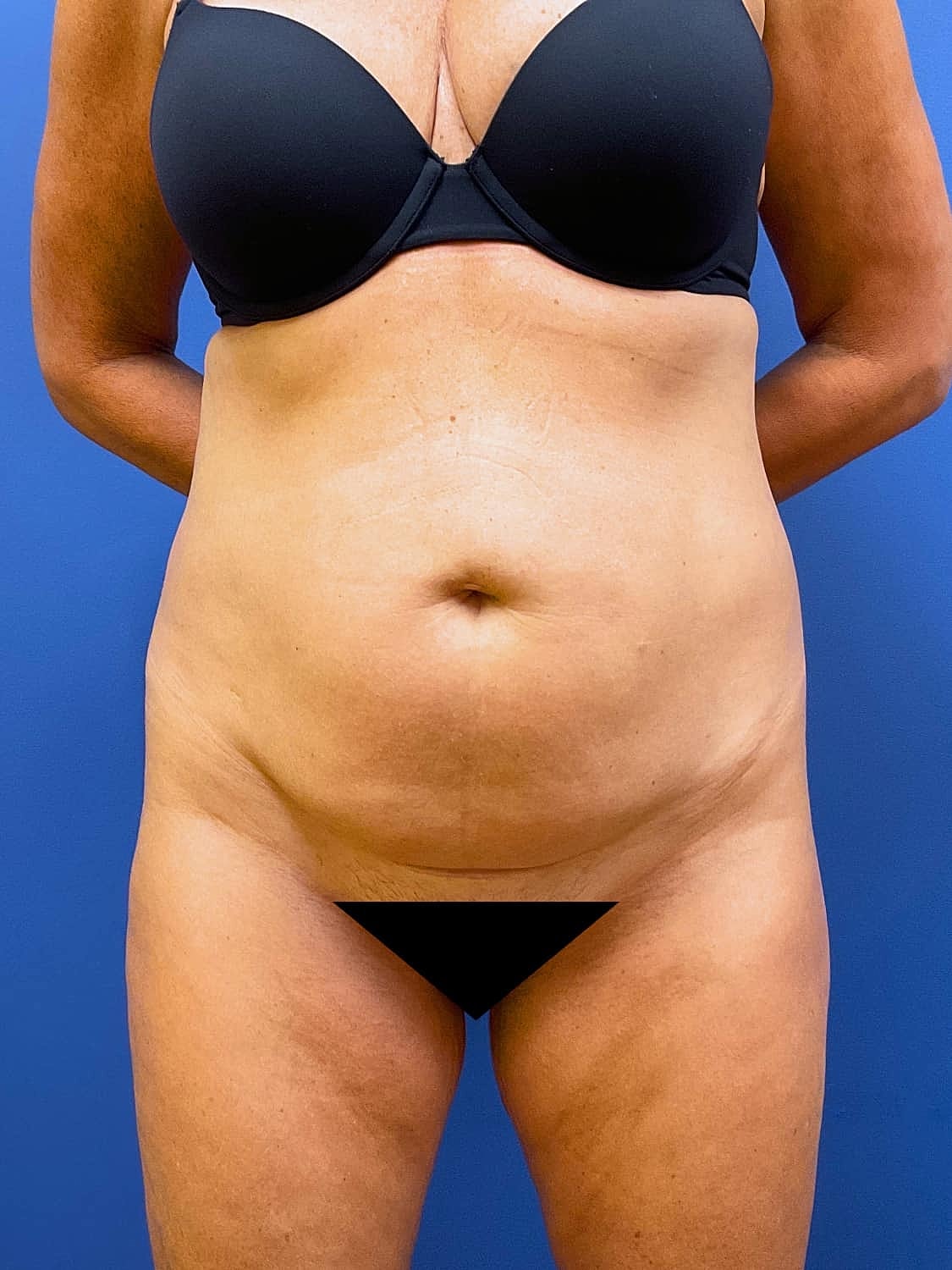 Liposuction Before & After