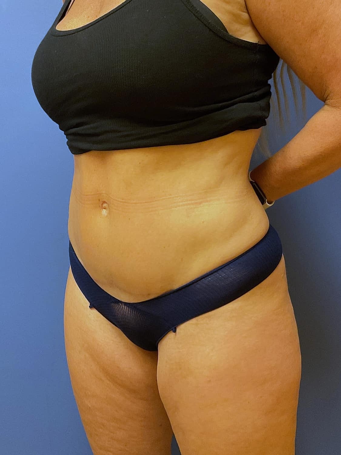 Liposuction Before & After