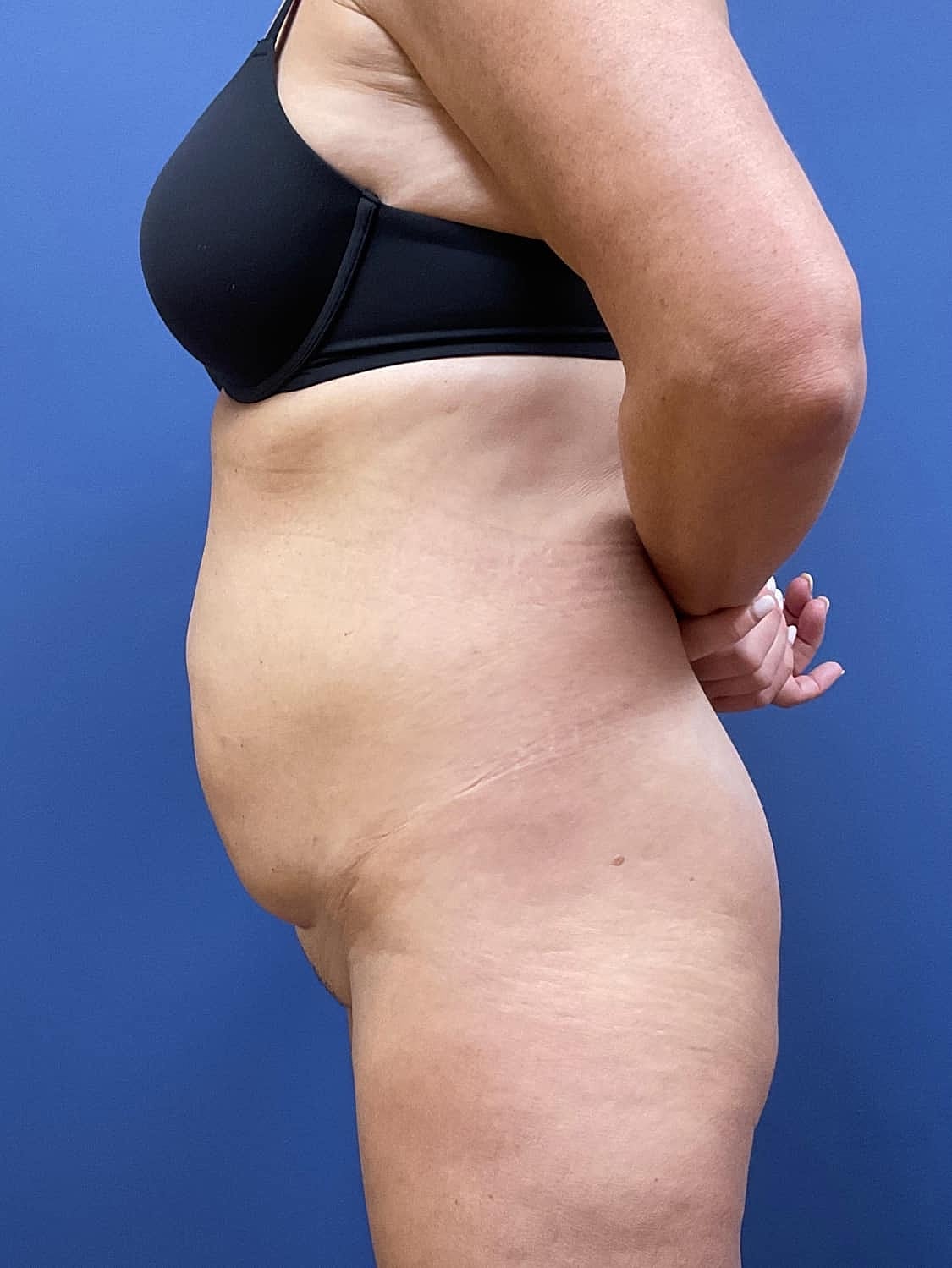 Liposuction Before & After