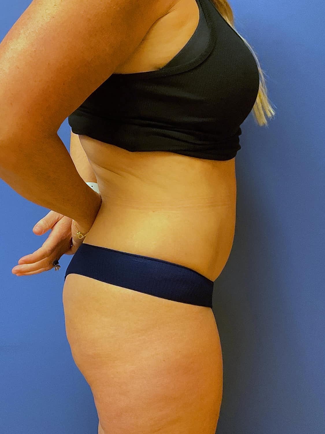 Liposuction Before & After