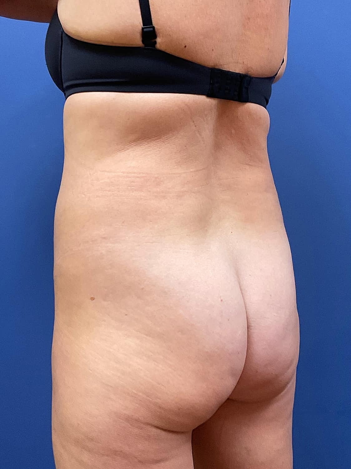 Liposuction Before & After