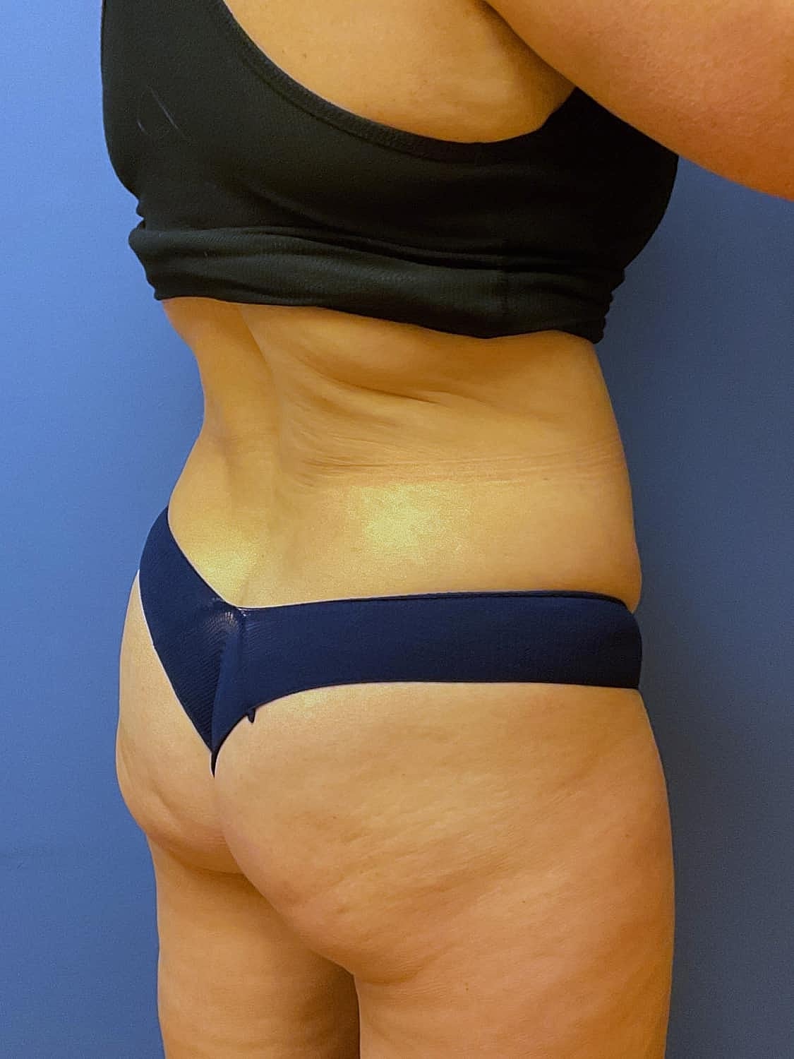 Liposuction Before & After