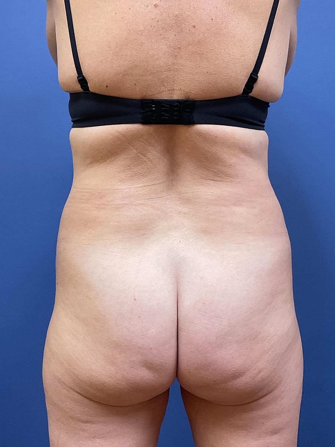 Liposuction Before & After