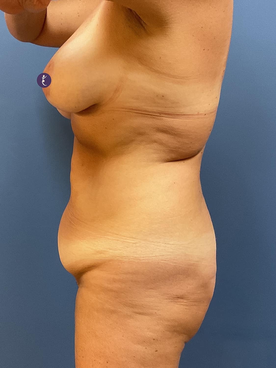 Liposuction Before & After