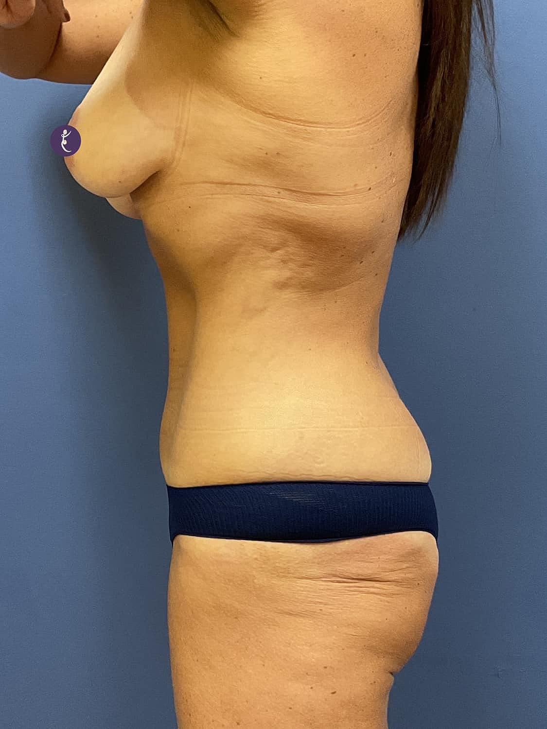 Liposuction Before & After