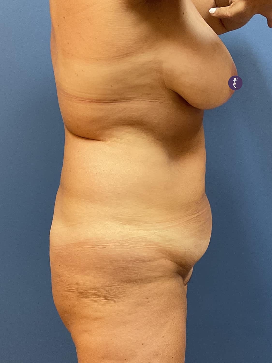 Liposuction Before & After