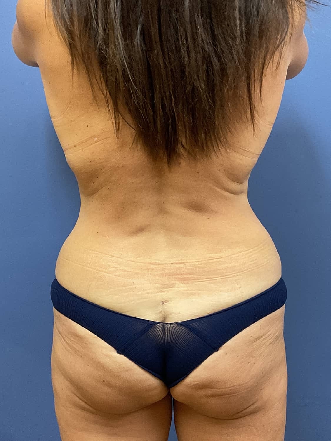 Liposuction Before & After