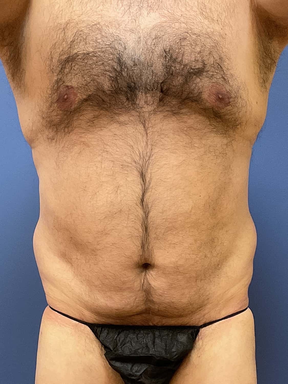 Liposuction Before & After