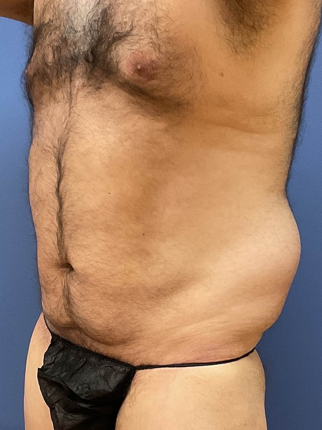 Liposuction Before & After