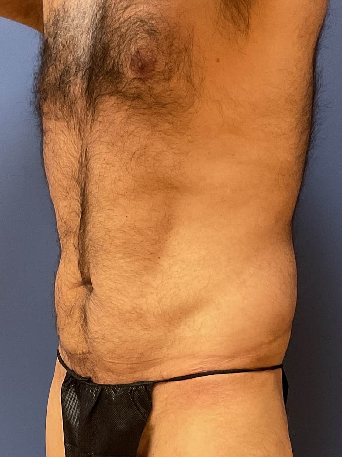 Liposuction Before & After