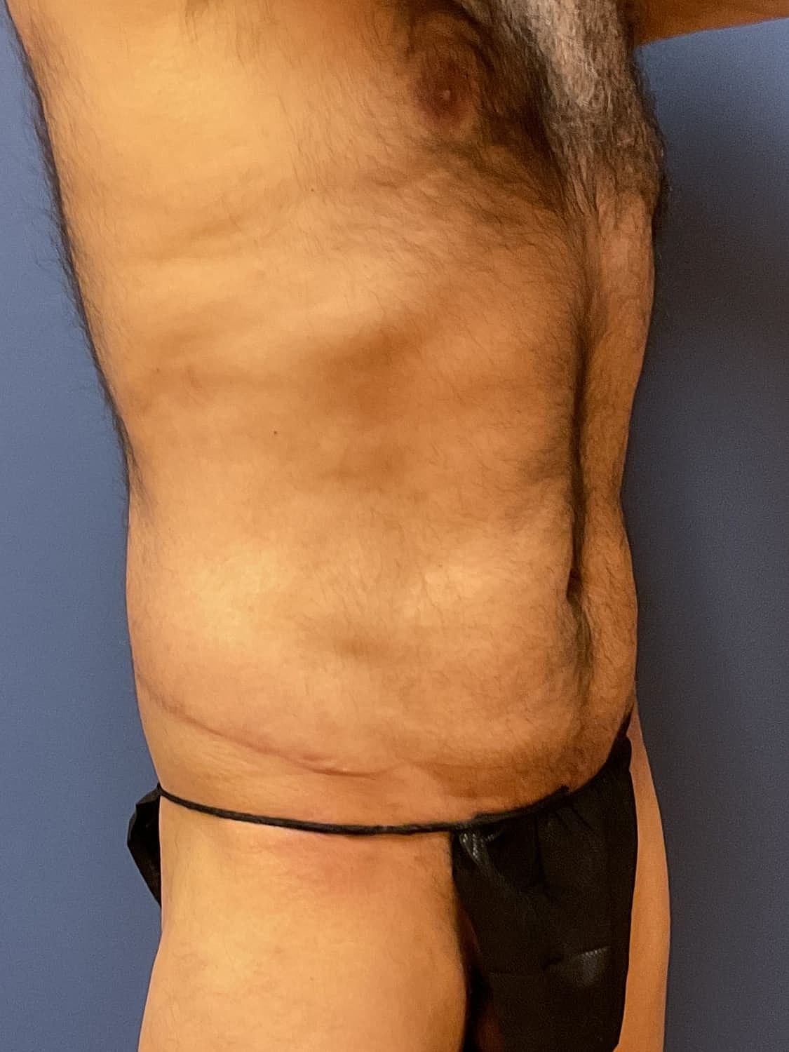 Liposuction Before & After