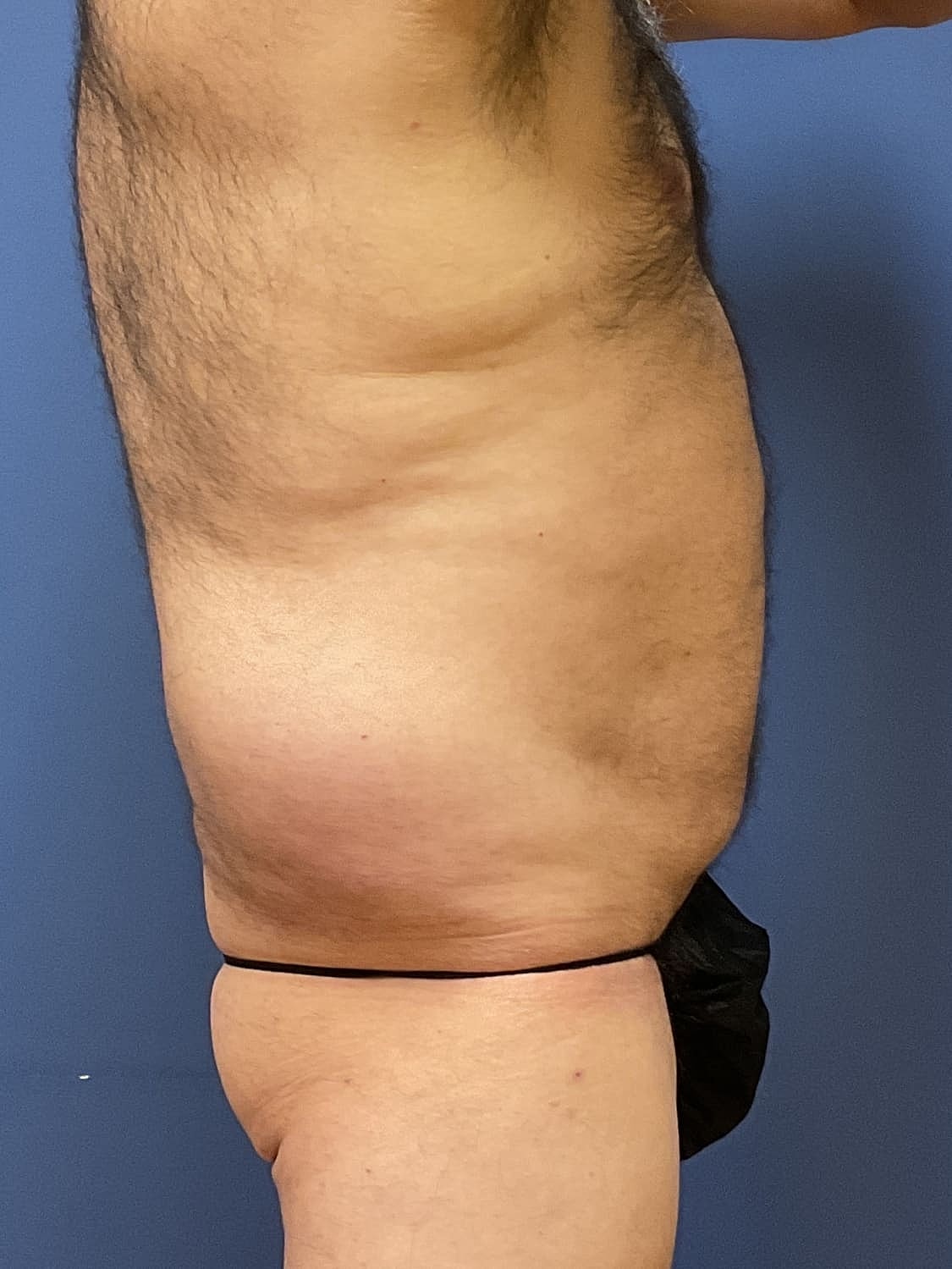 Liposuction Before & After