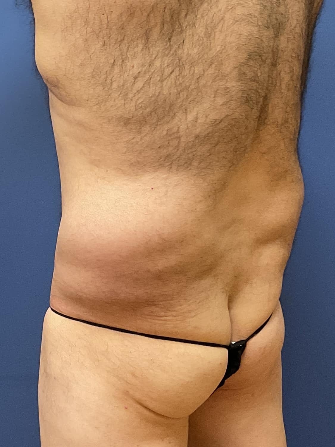 Liposuction Before & After