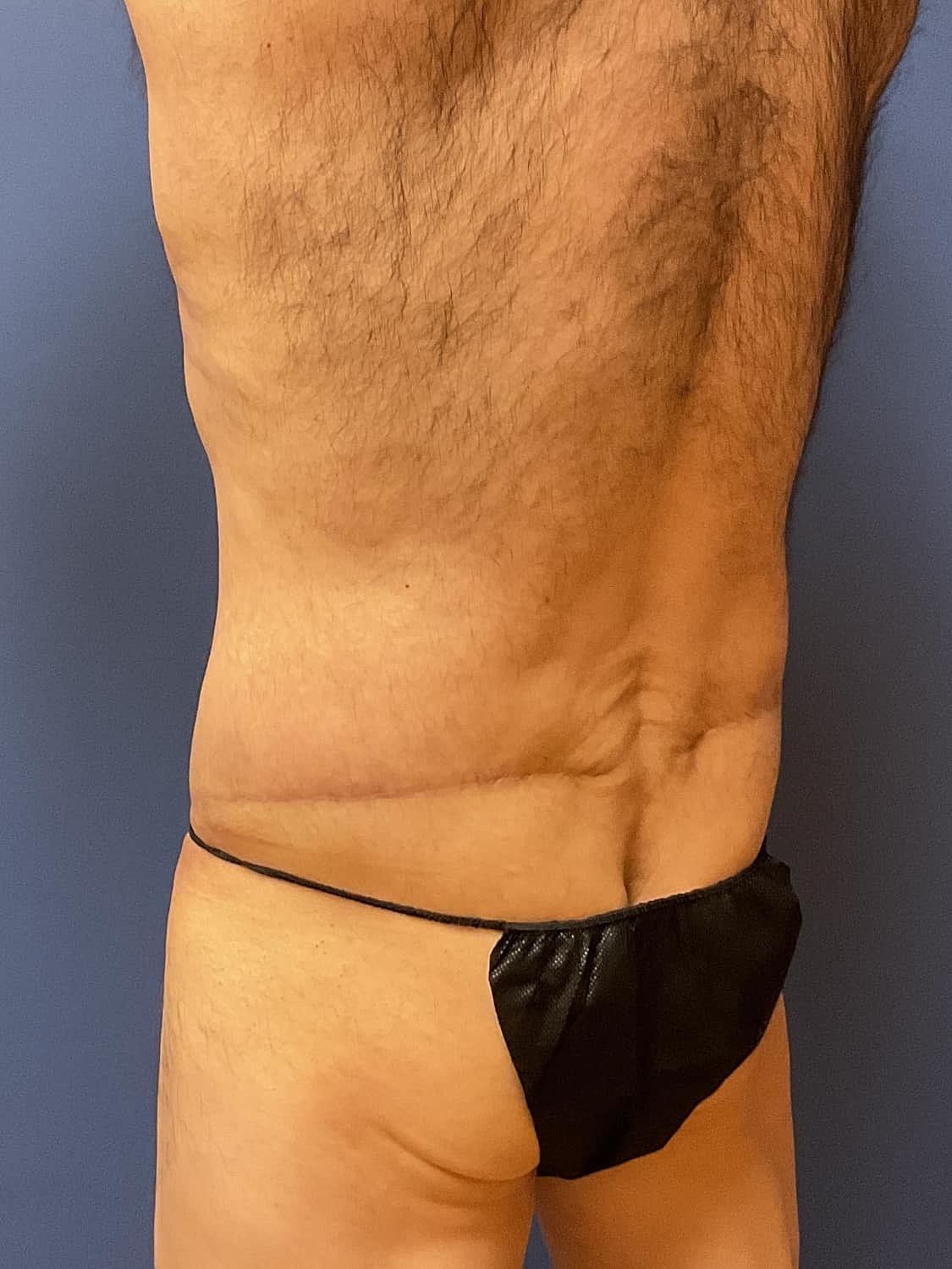 Liposuction Before & After