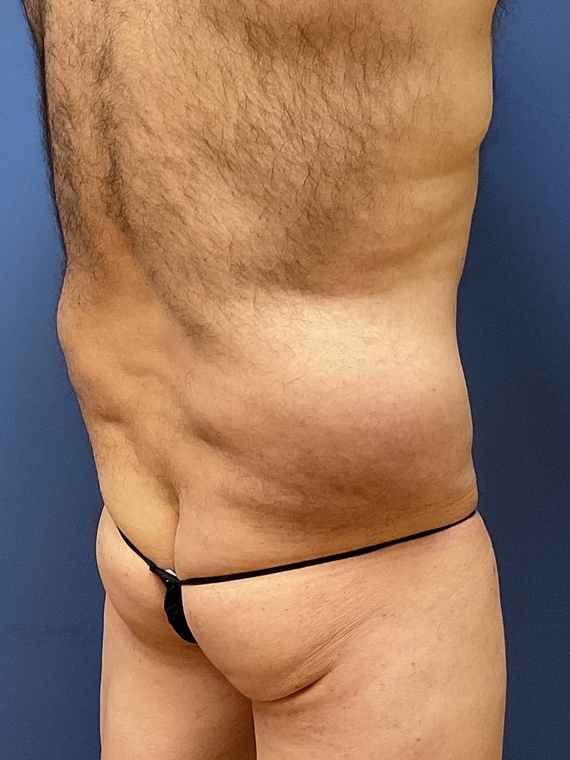 Liposuction Before & After