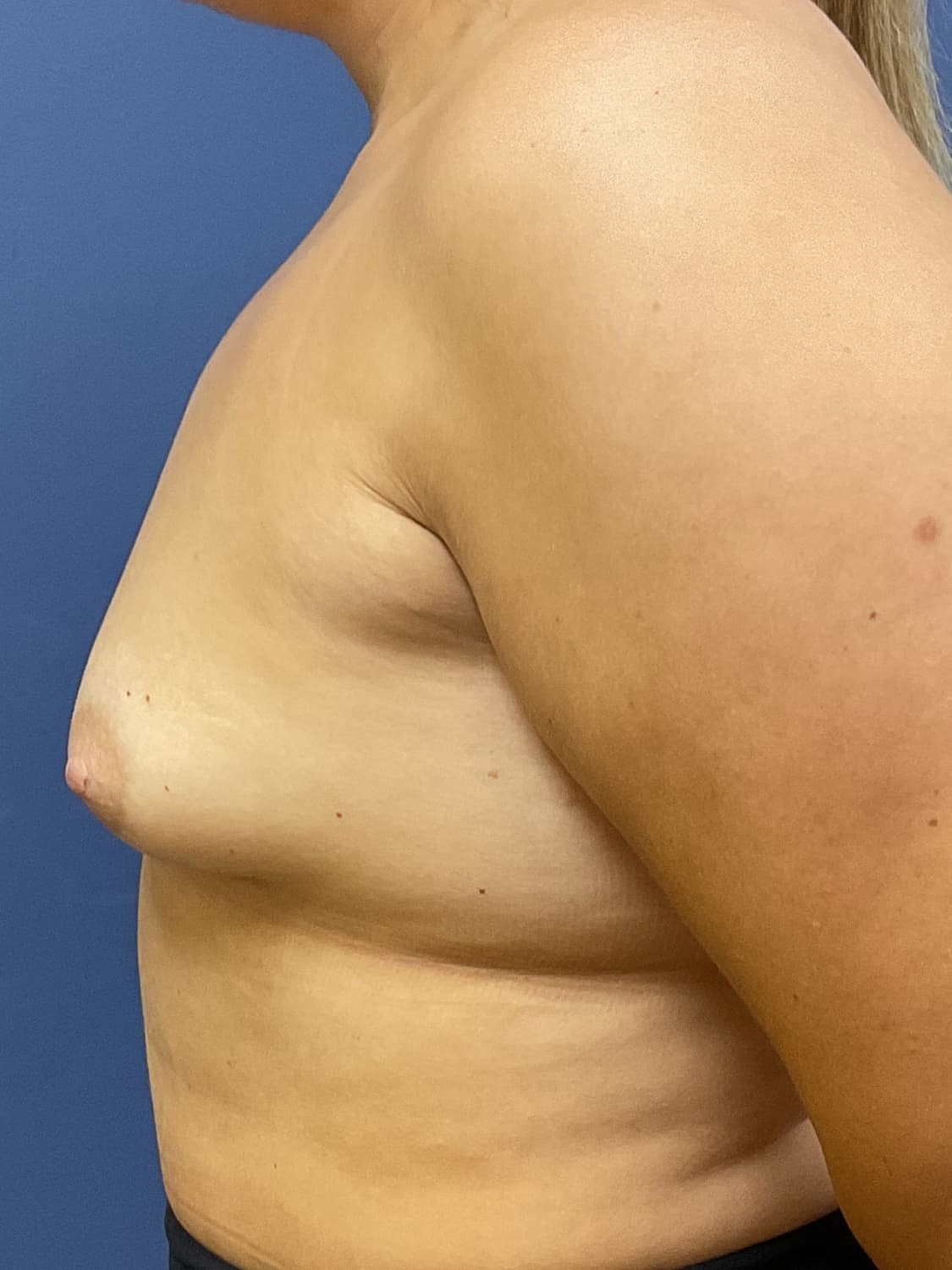 Liposuction Before & After