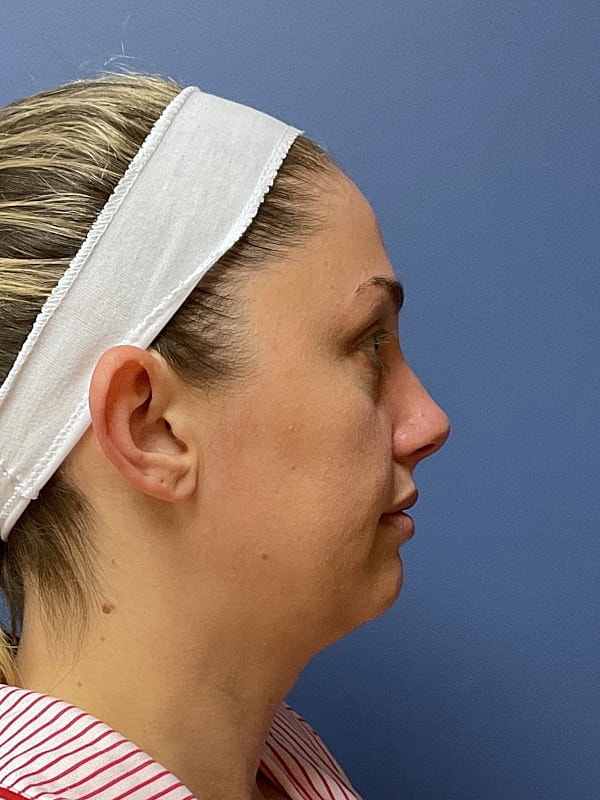 Liposuction Before & After